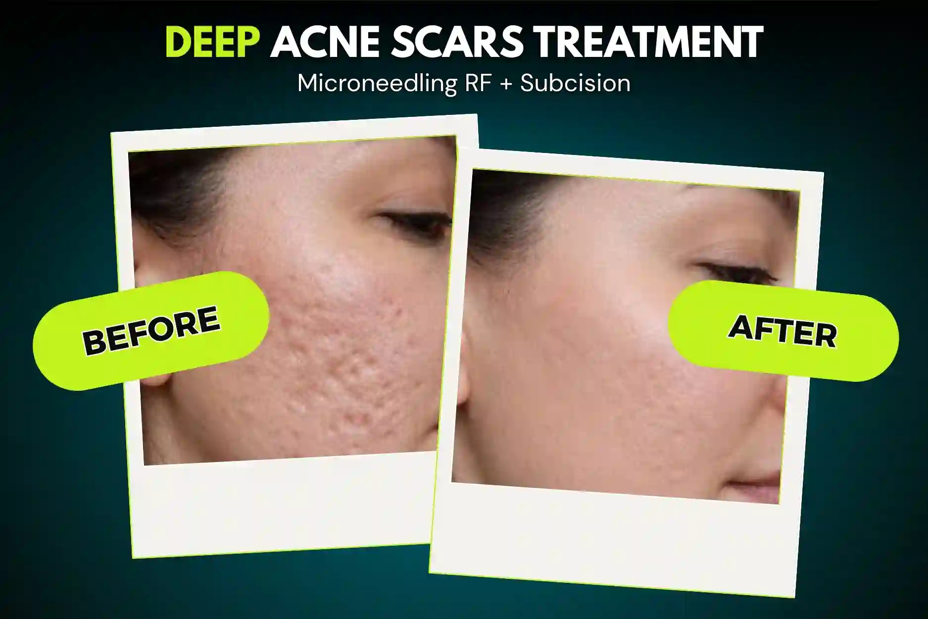 Acne Scar Treatment Before and After Results at SMC Aesthetics Karachi