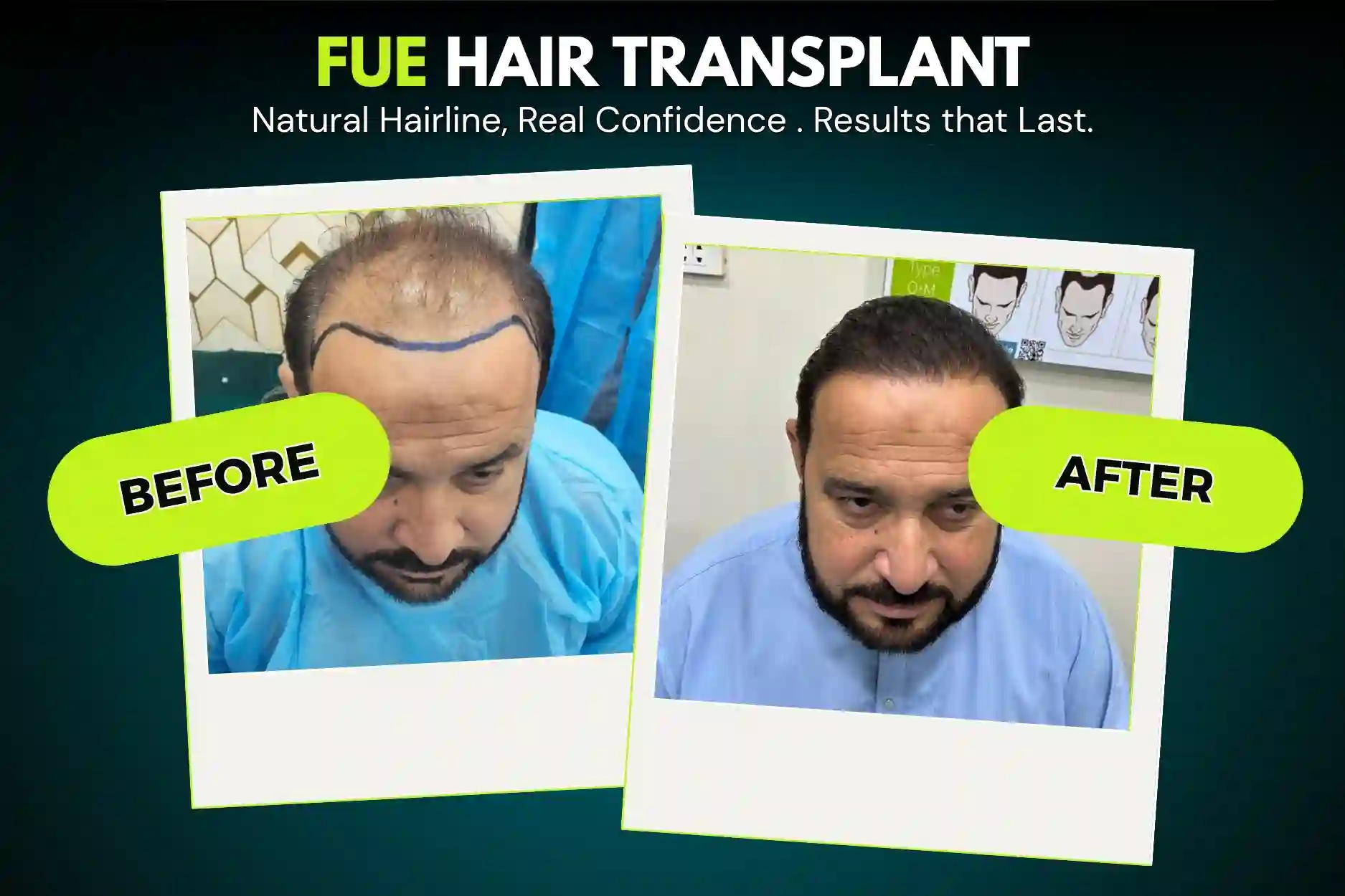 FUE Hair Transplant Before and After Results at SMC Aesthetics Karachi