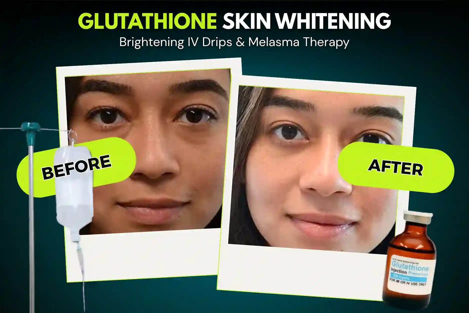 Glutathione Skin Whitening Before and After Results at SMC Aesthetics Karachi