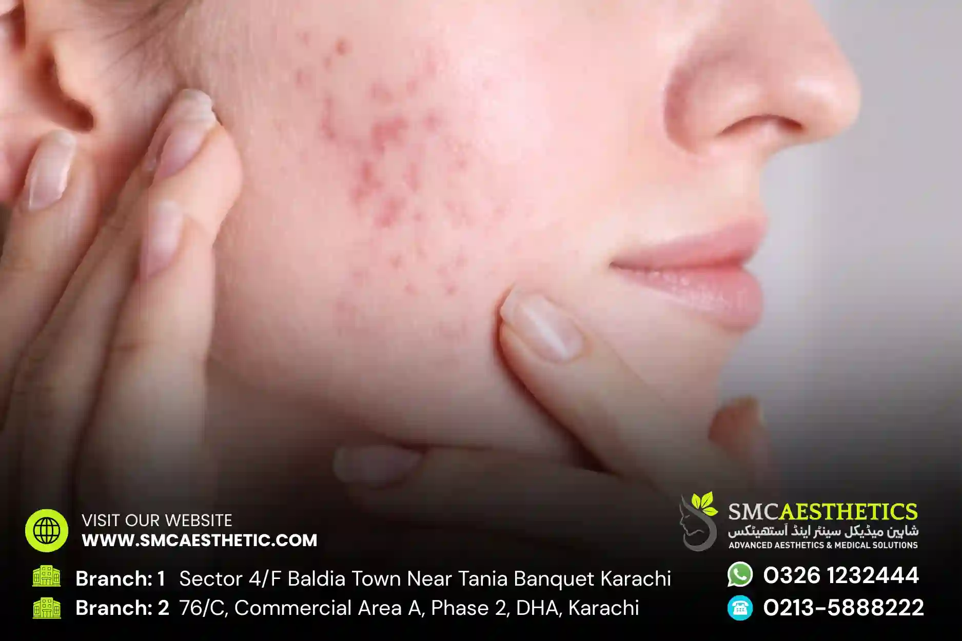 Acne Scar Treatment