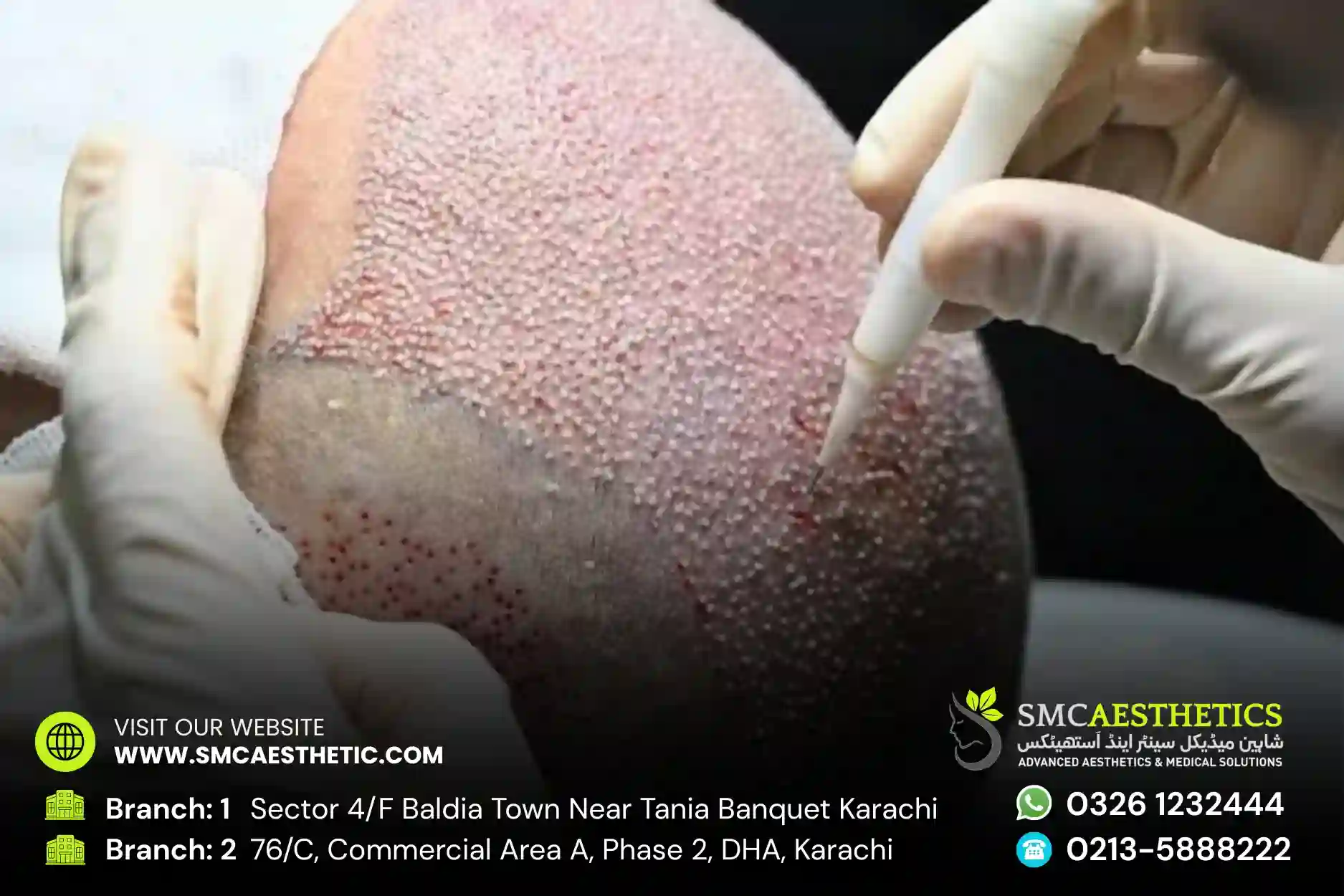 DHI Hair Transplant