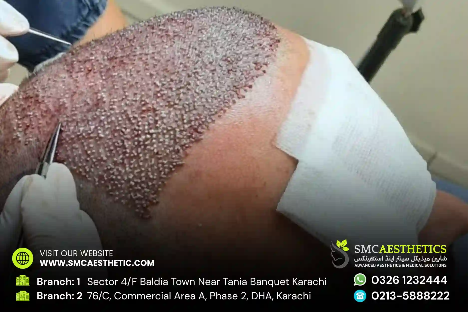 SMC Aesthetics Karachi - Premium Hair Transplant and Skin Care Clinic