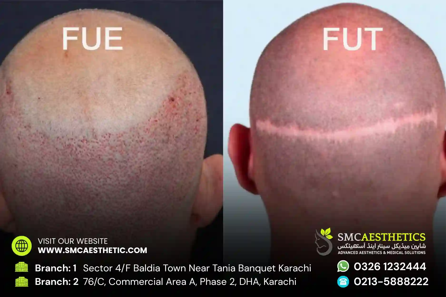 FUT Hair Transplant
