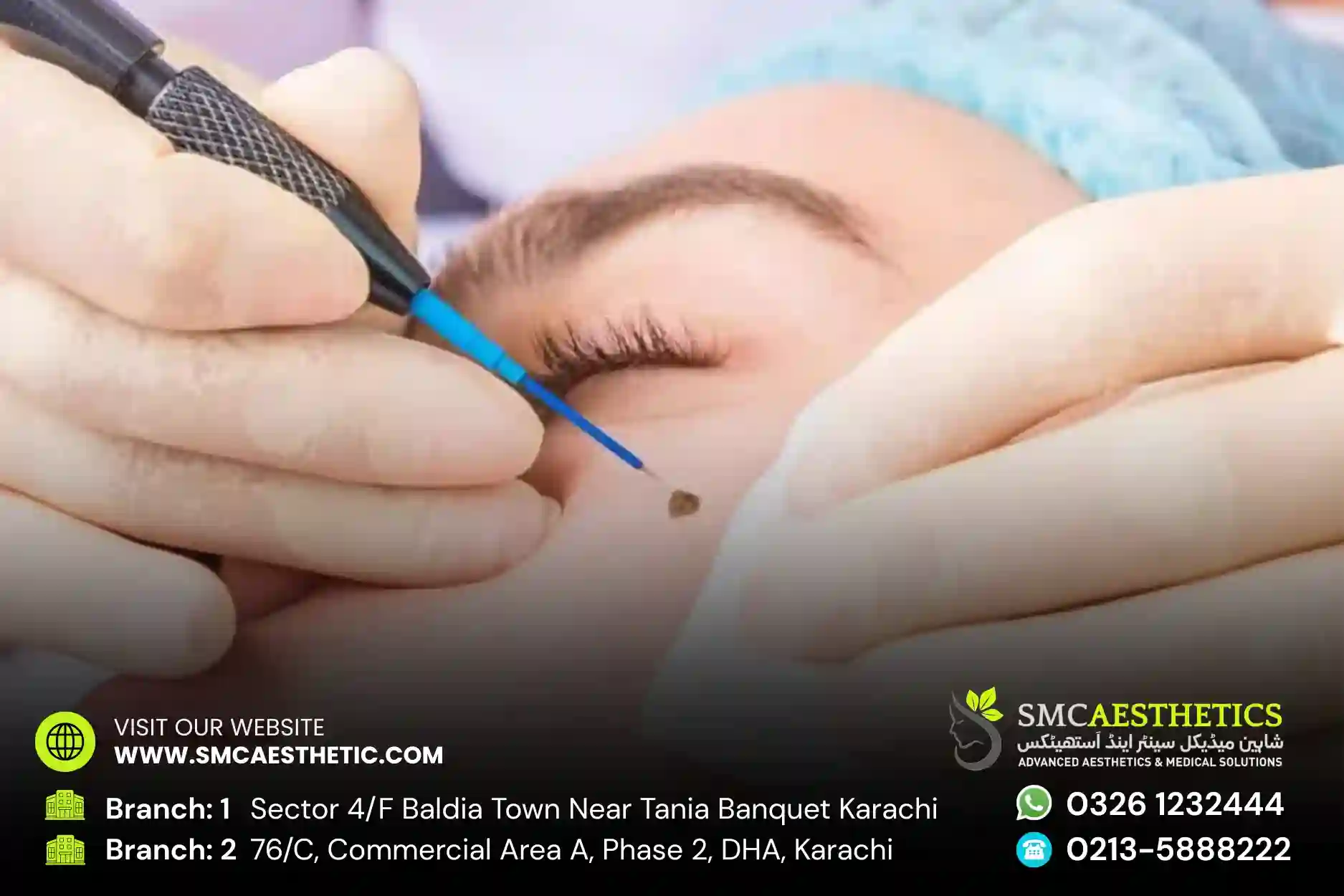 Moles & Warts Removal