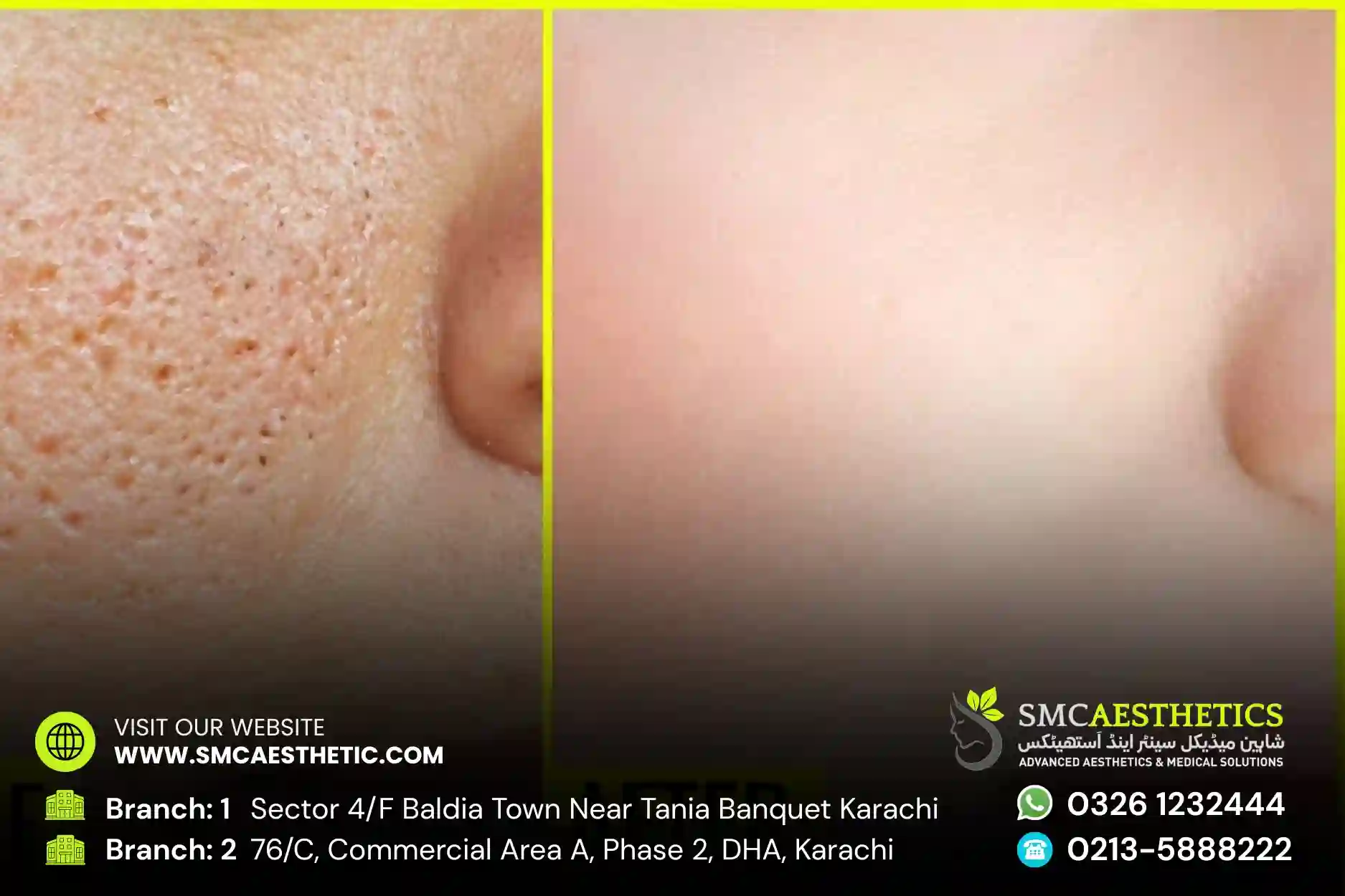 Open Pores Treatment