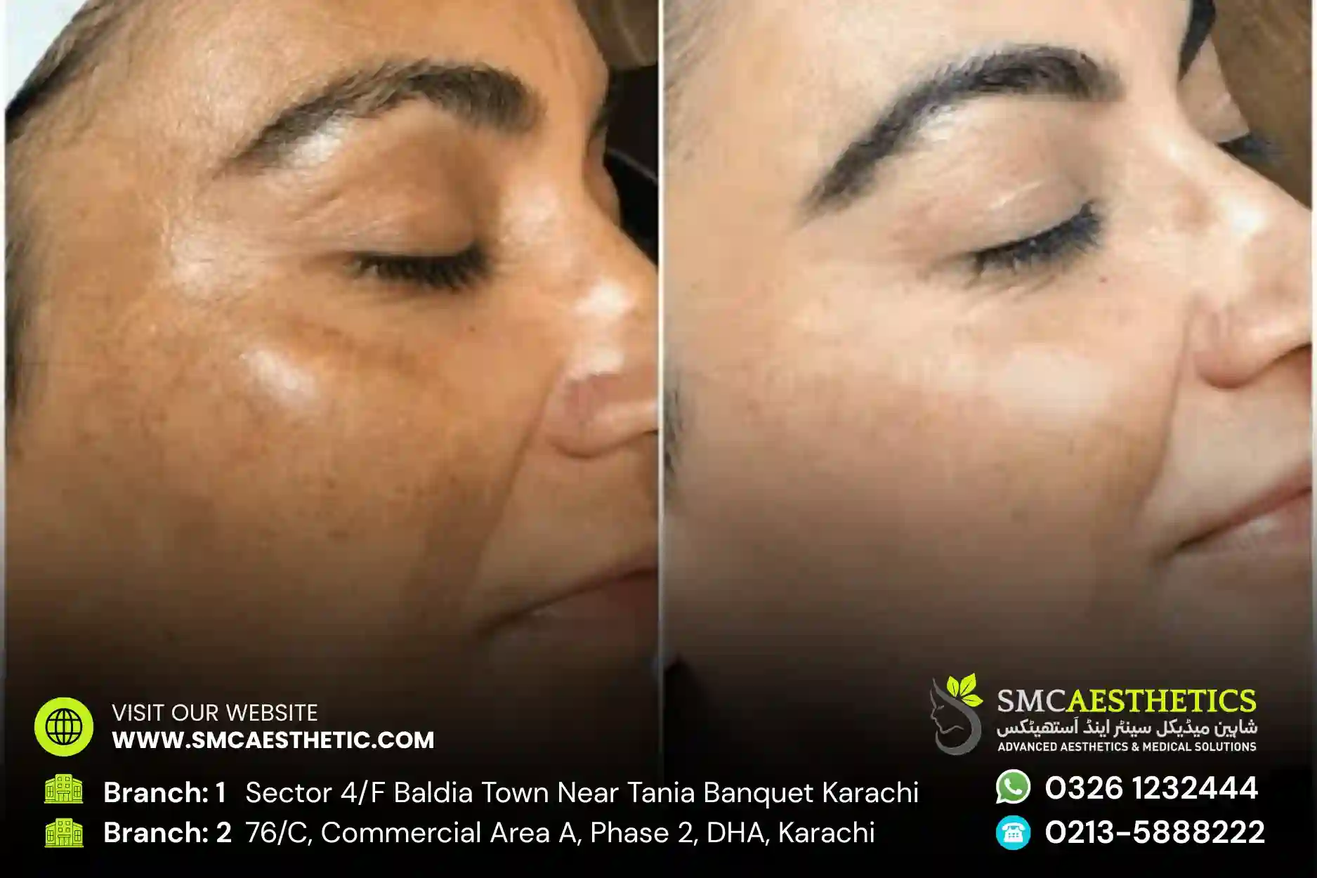 Pigmentation Treatment