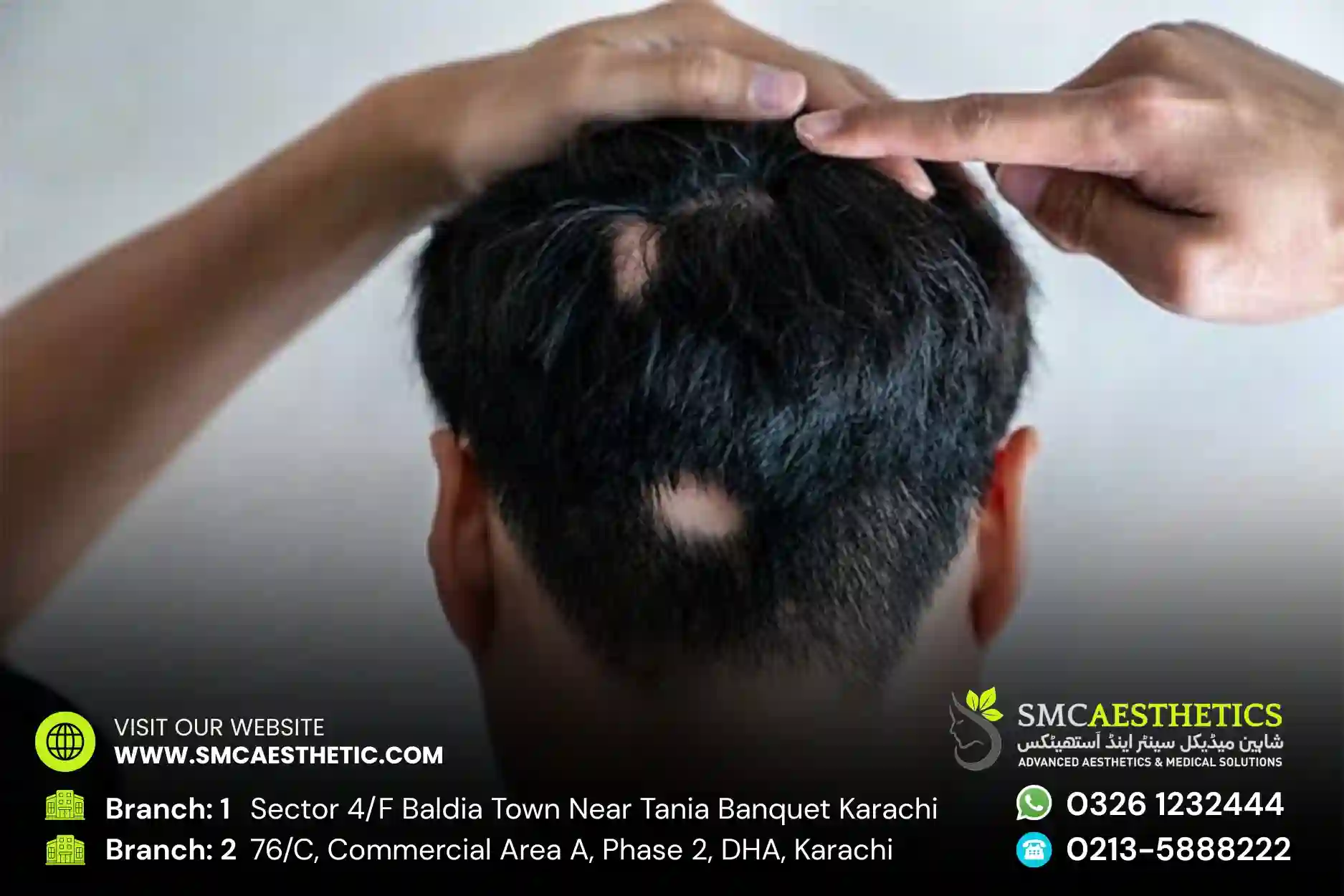 Female Hair Transplant in Karachi: Costs, Techniques & Non-Surgical Options (2026 Guide)